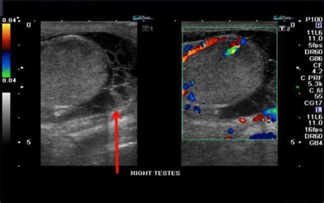 Epididymitis Basics - Protect the Jewels - County EM