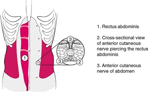 Abdominal Cutaneous Nerve Entrapment Syndrome (ACNES): A Not-So-Rare Cause of Abdominal Pain ...
