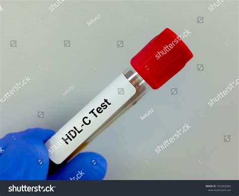 Blood Sample Hdlc Hdl Cholesterol Test Stock Photo 1952003665 ...