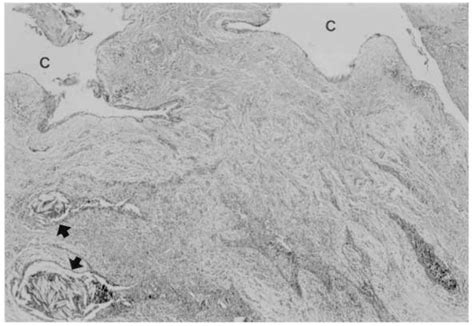 Cholesterol clefts and cysts lined with squamous epithelium (c: cyst,... | Download Scientific ...