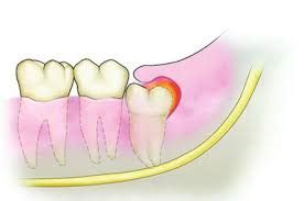 Pericorinitis – SMILE CREATION DENTAL