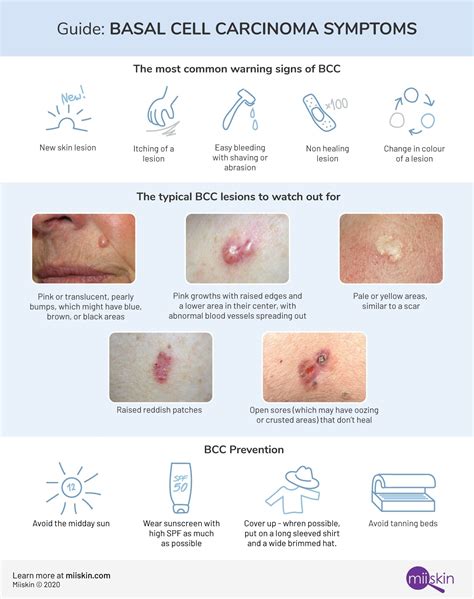 Basal Cell Carcinoma - Symptoms, Types and Pictures