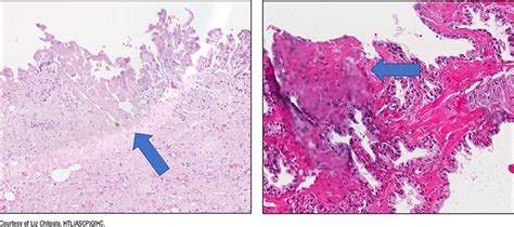 Histology_Fig5 - CAP TODAY