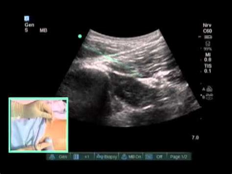 How To: Ultrasound Guided Subgluteal Sciatic Nerve Block Scanning Technique - YouTube