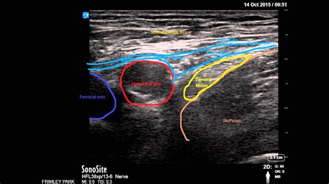 Ultrasound guided Femoral nerve block - YouTube