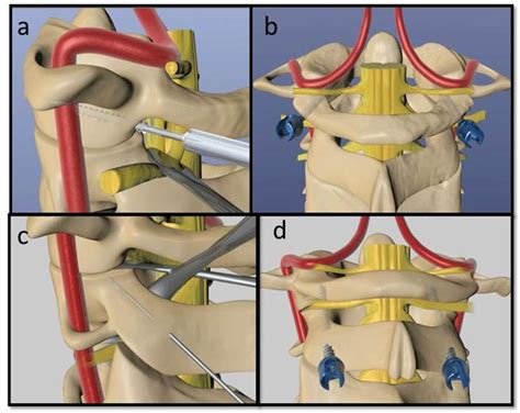 C1 C2 Subluxation Treatment - Pregnant Center Informations