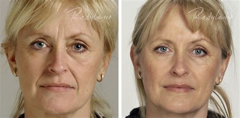 Restylane-Before and After-Dr Rita Rakus