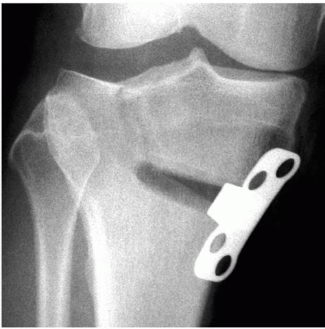 High Tibial Osteotomy in Knees with Associated Chronic Ligament ...