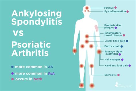 Ankylosing Spondylitis vs. Psoriatic Arthritis: Differences in Symptoms and Treatments