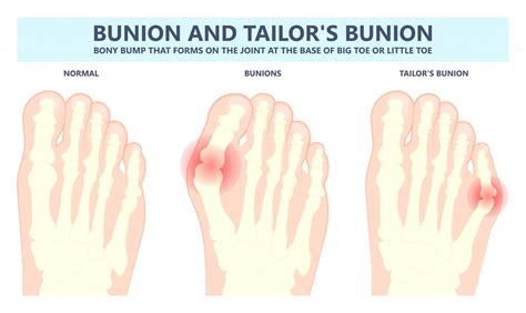 Tailor's Bunion | How to treat a Tailor's Bunion (Pinky Toe Bunion)