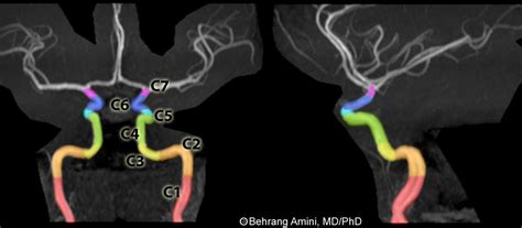 Roentgen Ray Reader: Segments of the Internal Carotid Artery