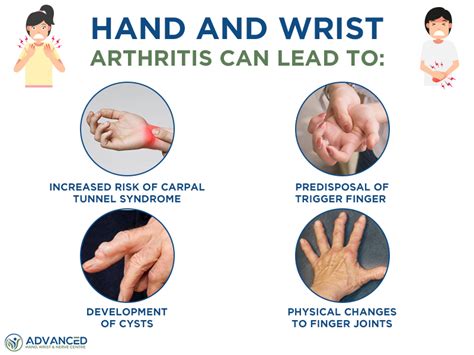 Therapy For Rheumatoid Arthritis In The Hand, 60% OFF