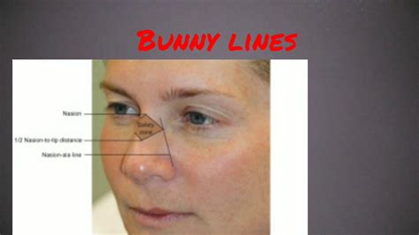 Chapter 3.. Botox injection for bunny lines - YouTube