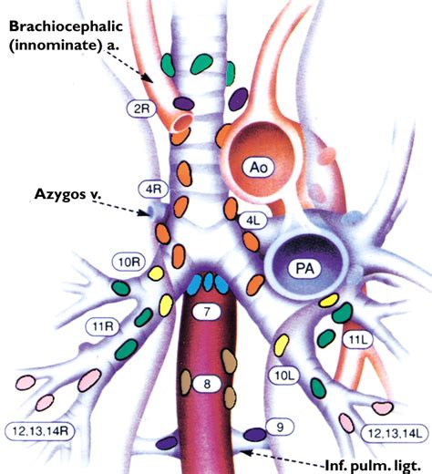 Tcancer Lymph Node Mapping