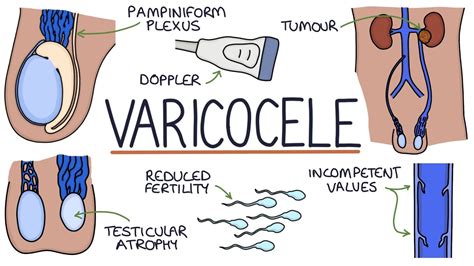 Varicoceles - YouTube