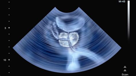 Transrectal ultrasound: Preparation, procedure, cost, and more