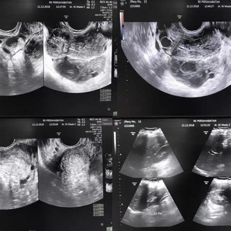 Ultrasound findings (transrectal) | Download Scientific Diagram