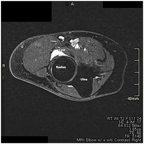 Ganglion Cyst In The Elbow A Case Study With A Rare Presentation 92160 | Hot Sex Picture