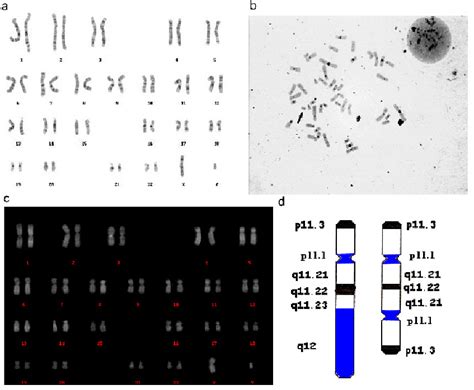 Cytogenetics a) GTG Karyotype: 45,X[18]/46,XY,idic(Y)q(11.2)[82]. The Y... | Download Scientific ...