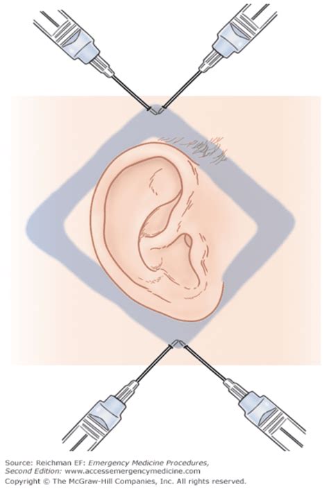 emDOCs.net – Emergency Medicine EducationR.E.B.E.L. EM - Auricular Hematoma Management - emDOCs ...