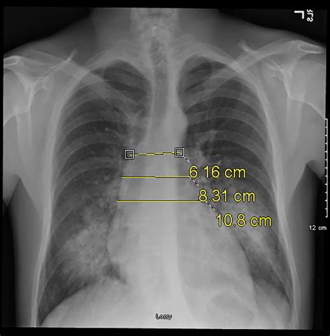 Aortic Dissection X Ray - Aortic Dissection - CXR Findings | Aortic ...