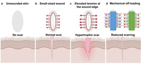 The presence of mechanical tension across skin wounds worsens scarring.... | Download Scientific ...