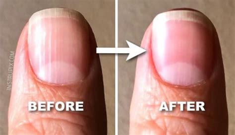 What Those Vertical Lines On Your Nails Mean About Your Health