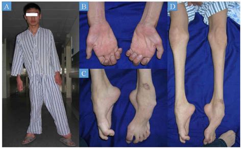 Charcot Marie Tooth Syndrome - Meulin