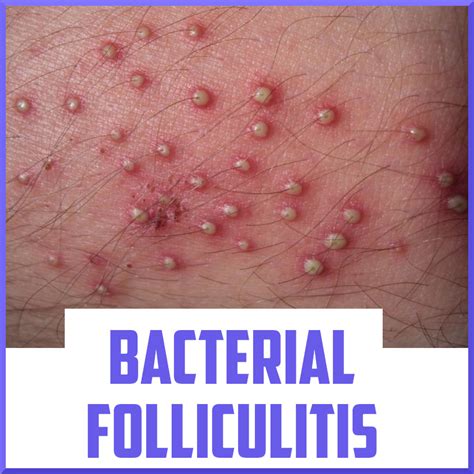 Recognizing and Treating Bacterial Folliculitis- Sports Medicine Review