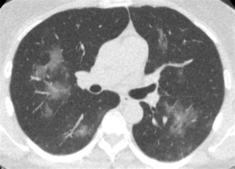 Diagnosing COVID-19 infection by enhanced CT scan | Total Health