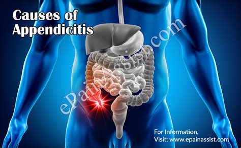 Appendicitis: Treatment, Causes, Symptoms, Signs, Risk Factors