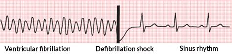 Becoming Familiar with Synchronized Cardioversion | CareerCert