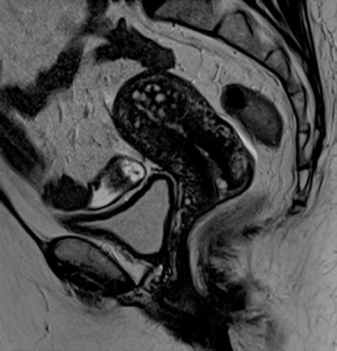 Adenomyosis and MRI: What you need to know and be aware of | Semantic Scholar