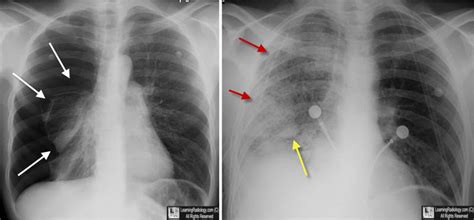 Learning Radiology - Reexpansion, re-expansion, Pulmonary, Edema