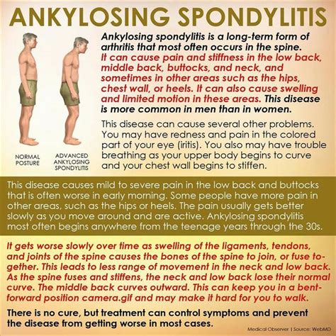 Posture | Ankylosing spondylitis, Anklosing spondylitis, Arthritis