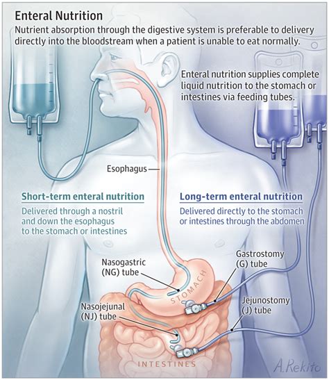 Enteral Nutrition | Critical Care Medicine | JAMA | JAMA Network