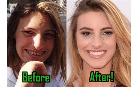 Lele Pons: Plastic Surgery of Nose Job, Before and After Photos ...