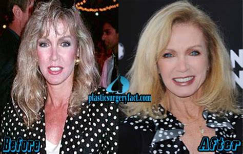 Donna Mills Plastic Surgery Before and After Photos