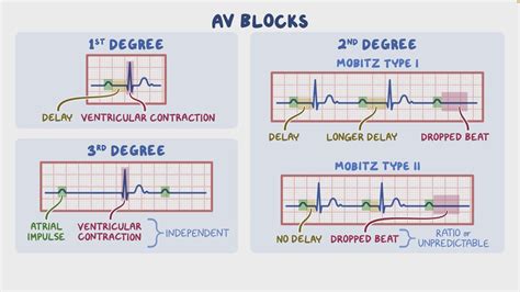 Arrhythmias - Heart blocks: Nursing - Osmosis Video Library