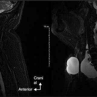 MRI in sagittal T2 section showing the anterior meningocele | Download Scientific Diagram