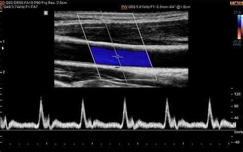 File:Spurious spectral broadening (ultrasound) (Radiopaedia 74129-84944 Small sampling gate ...