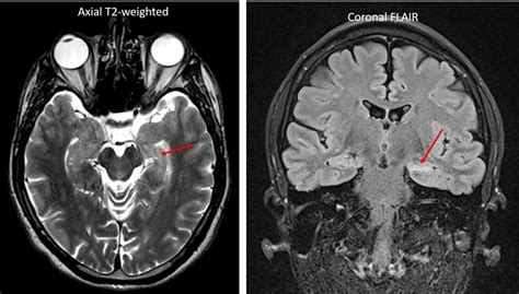 Mesial temporal sclerosis – Radiology Cases