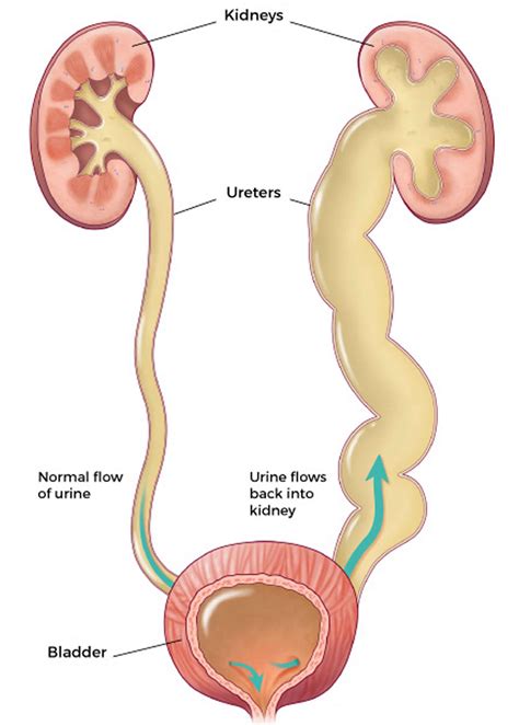 Vesicoureteral reflux causes, grading, symptoms, diagnosis & treatment