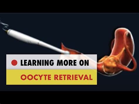 Oocyte Retrieval - YouTube