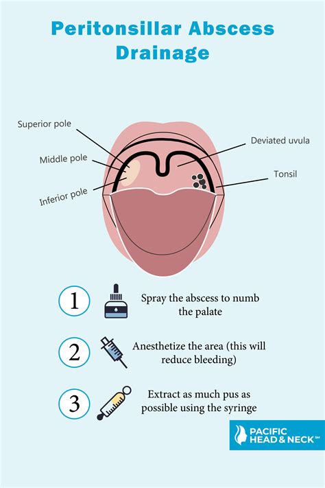 Peritonsillar Abscess Picture