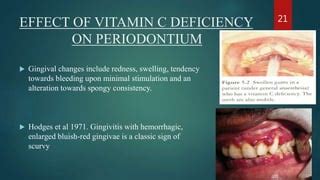 Vitamin C and Periodontal Health | PPT