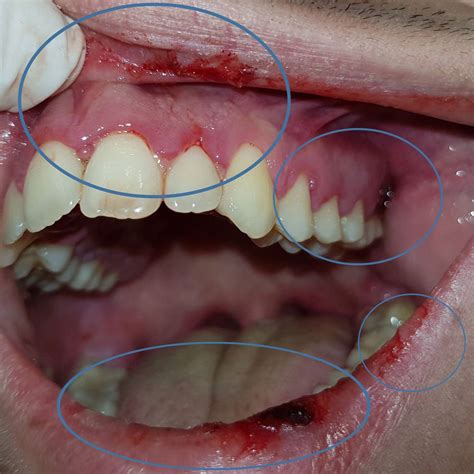 Herpetic Lesions - Titsinides Savvas - Oral Medicine - Oral Surgery Specialist