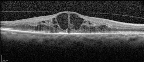 OCT image showing cystoid macular edema - Endotext