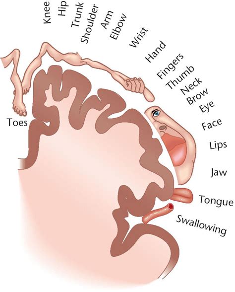 Homunculus Infarct and Lower Extremity Paralysis