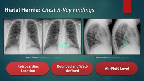 Hiatal Hernia: Chest X-Ray Findings | Nursing school survival, X ray, School survival